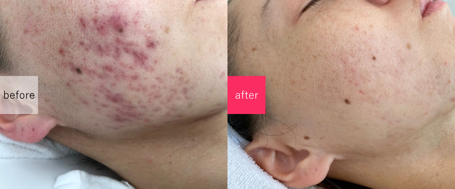 ニキビ改善エステサロン　ロゼルナの施術事例