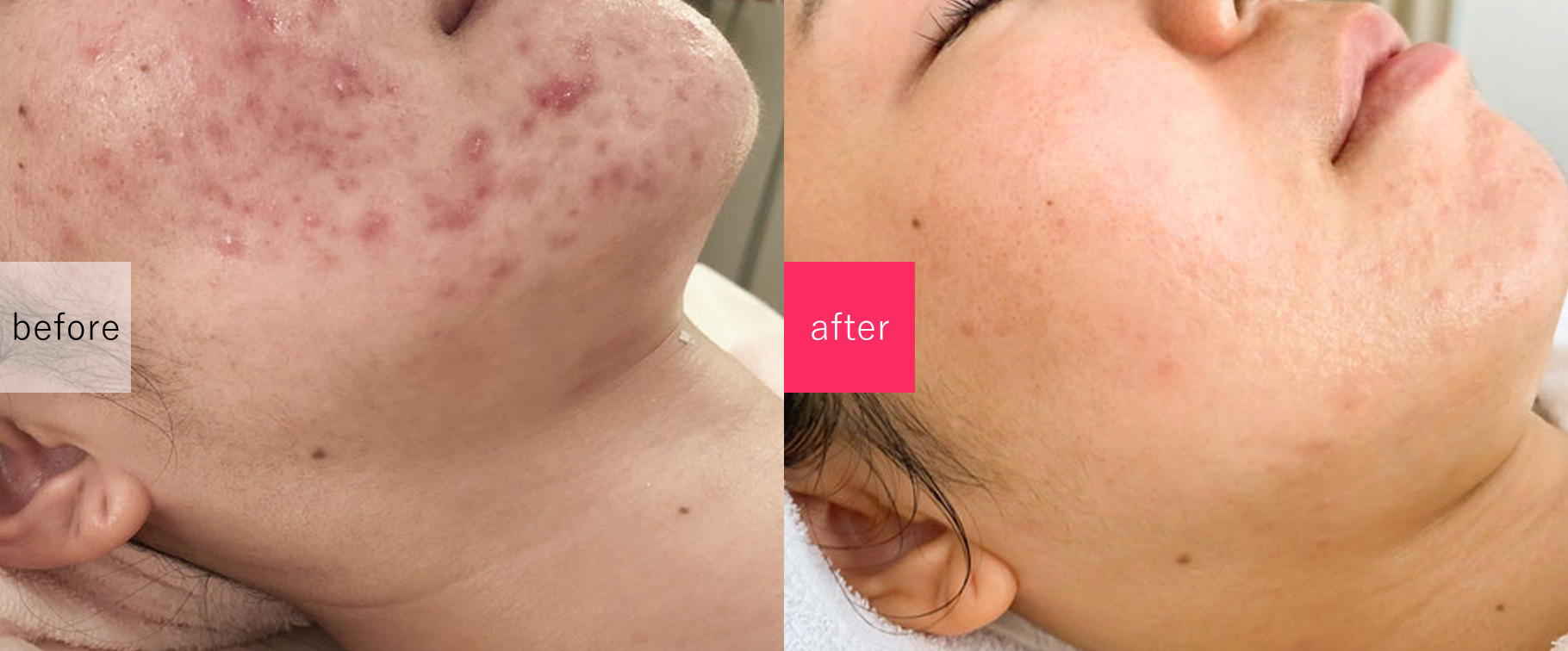 ニキビ改善エステサロン　ロゼルナの施術事例
