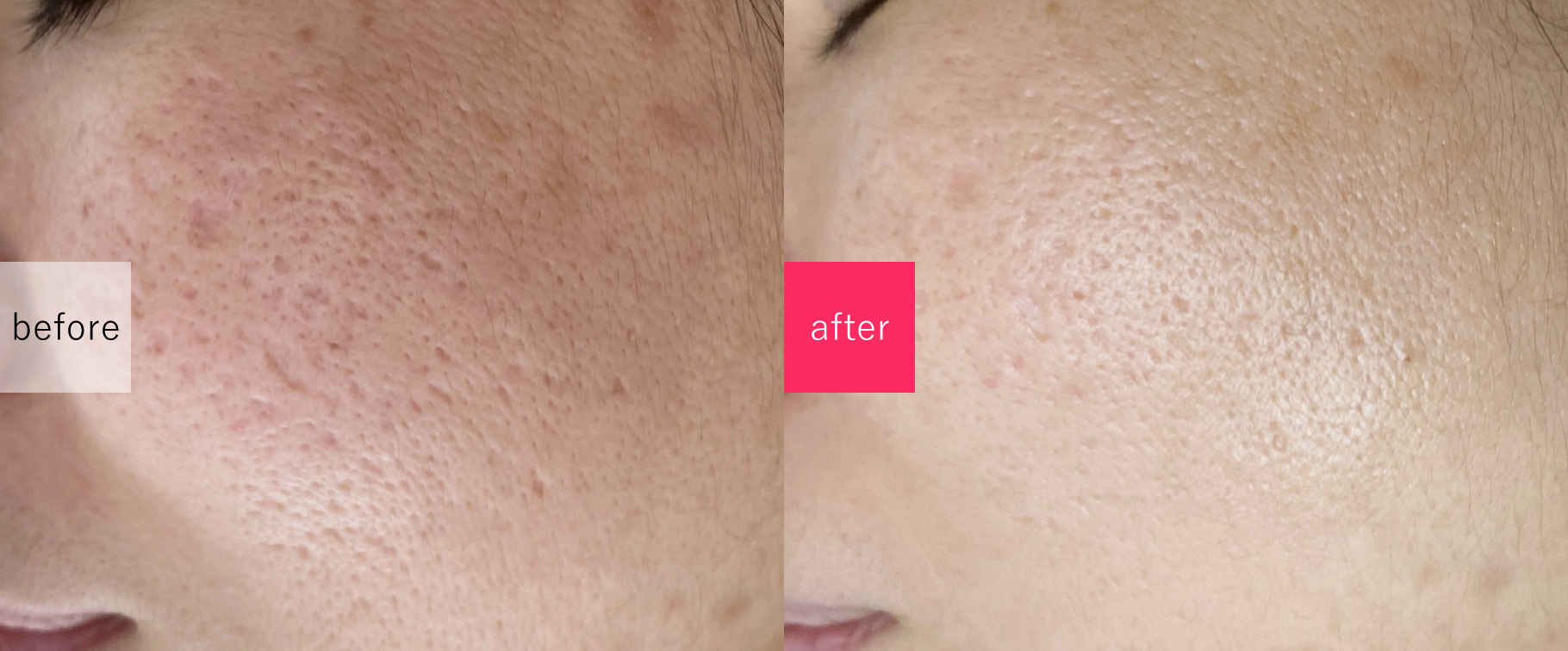 ニキビ改善エステサロン　ロゼルナの施術事例
