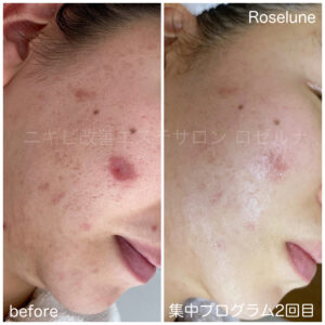 ニキビ跡に何をしたら良いのか迷っていませんか？