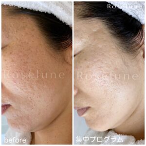 エステでクレーターは本当に変わりますか？