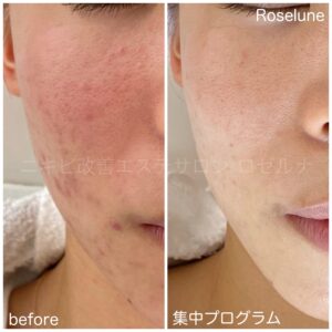 ニキビ跡に赤みがあって化粧崩れもあるなら、まずはロゼルナでケアを