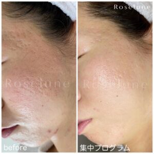 レーザー治療をする前に必ず確認して欲しいこと