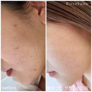 クレーター肌が年々酷くなっている方の共通点