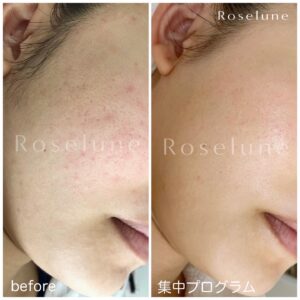 クレーター肌が変わったと感じるには距離感が大切