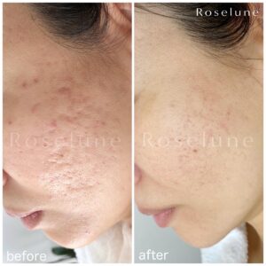 絶望的なニキビ跡に変化があった。一生分の価値を教わりました