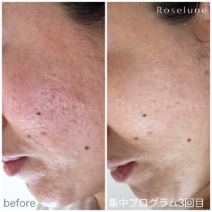 エステでクレーターは治りますか？