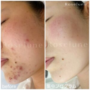 白ニキビはどうしてできるの？