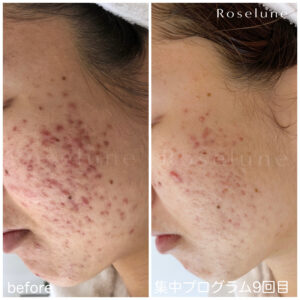 赤みのあるニキビ跡もこんなに落ち着きました