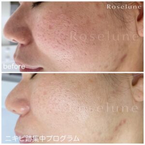 クレーター肌の方に多いフェイスライン、あご下のニキビがみるみる減る方法