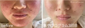 ロゼルナモイスチャーエッセンスを使ったWさまのお肌の変化