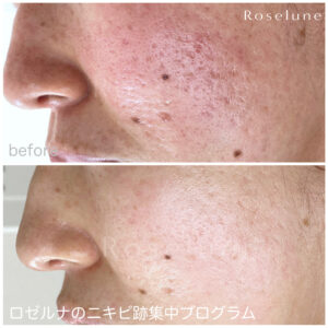 エステでクレーターは治りますか？