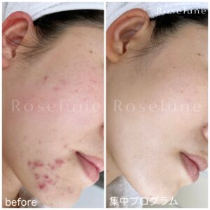 美容クリニックではニキビができやすい体質までは変えられない