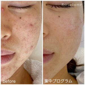 ニキビを克服した元看護師Kさま（28歳）の症例