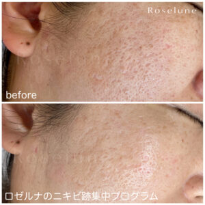 ポテンツァ（Potenza)はニキビ跡のクレーターに効果がありますか？