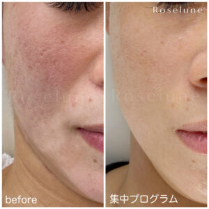 ニキビ跡の色素沈着以外にも気になるシミやくすみも変わりますか？