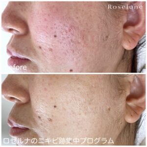 クレーター肌専門サロンのプロが見極めるダーマペンをやってはいけない肌とは