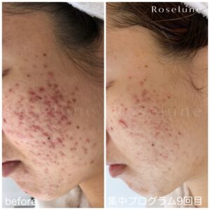 ニキビができなくなれば、それで良いですか？