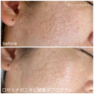 私のクレーターはどのくらい治る見込みがありますか？４ヶ月でどのくらい変わりますか？