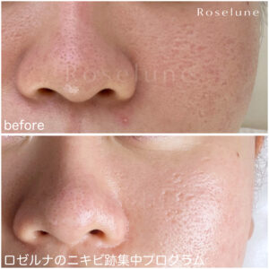 花粉の時期は、ニキビが余計に酷くなったりしていませんか？