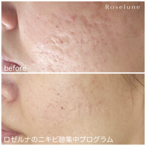 ネット上にあるニキビ跡改善の方法であなたのニキビ跡が変わらない理由