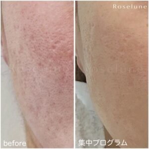 皮膚科では治せないと言われてしまったニキビ跡