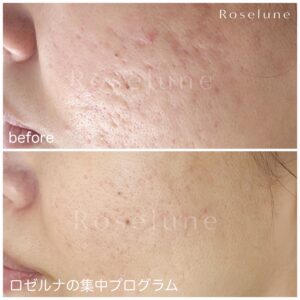 ダウンタイムが辛くて続けられなかったからクレーター治療は諦めてました