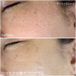 クレーター改善できたとして、通わなくなったらまた元に戻ってしまわないか心配です