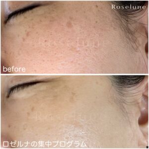 クレーター改善できたとして、通わなくなったらまた元に戻ってしまわないか心配です