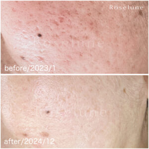 クレーター肌、これからもっと目立つかも…？