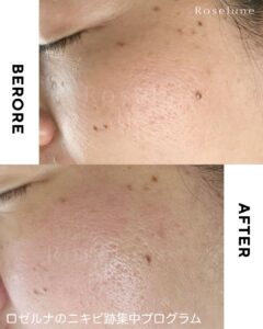 クレーター治療の常識を変えるロゼルナのケア