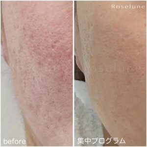 ニキビやニキビ跡クレーターが改善できる秘訣はマインド