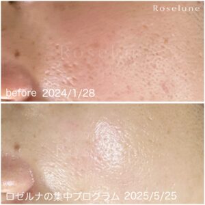 ニキビは潰してないのにクレーターになってしまった