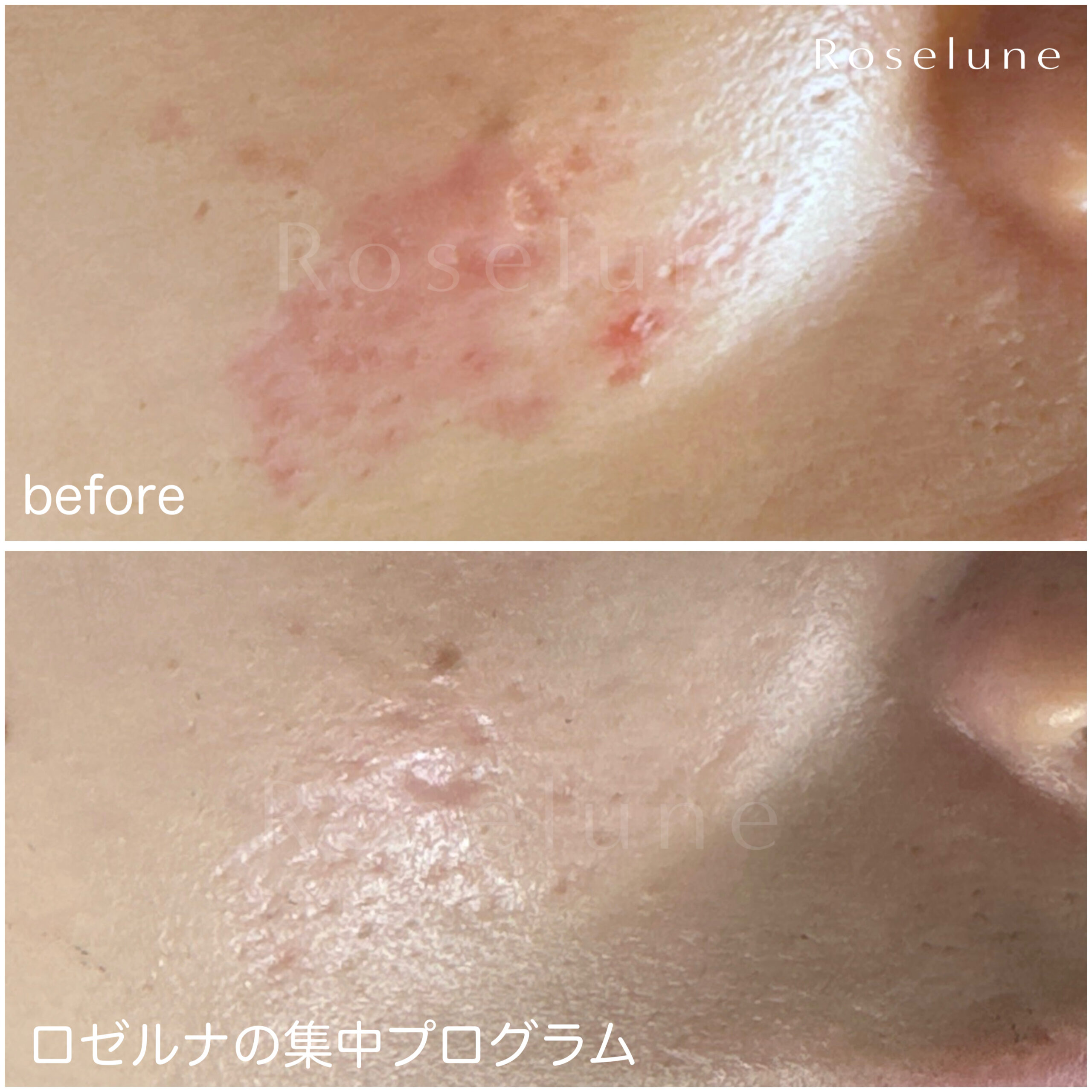 サブシジョンを受けたHさまのビフォーアフター写真