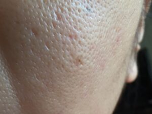 40代50代クレーター肌・もう治らないと諦める前に知ってほしいこと
